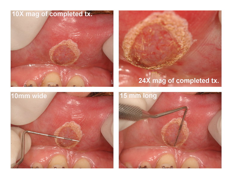 JP frenectomy edited pg 4_resize.jpg